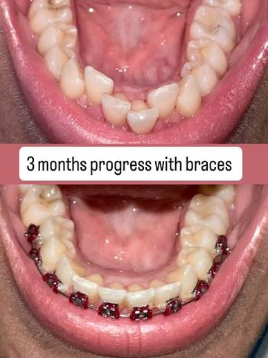 Orthodontic Transformation